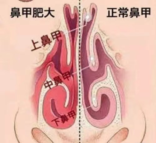 鼻甲肥大鼻塞的最佳治疗药,鼻息肉鼻塞最好的治疗方法