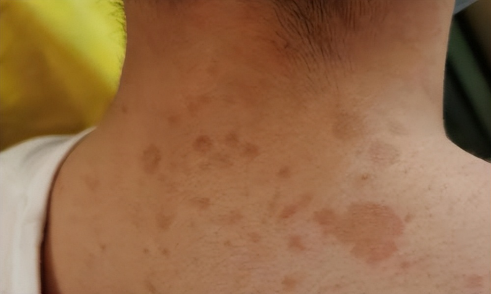一到夏季，后背长了一些褐色的斑点，这是什么皮肤病？