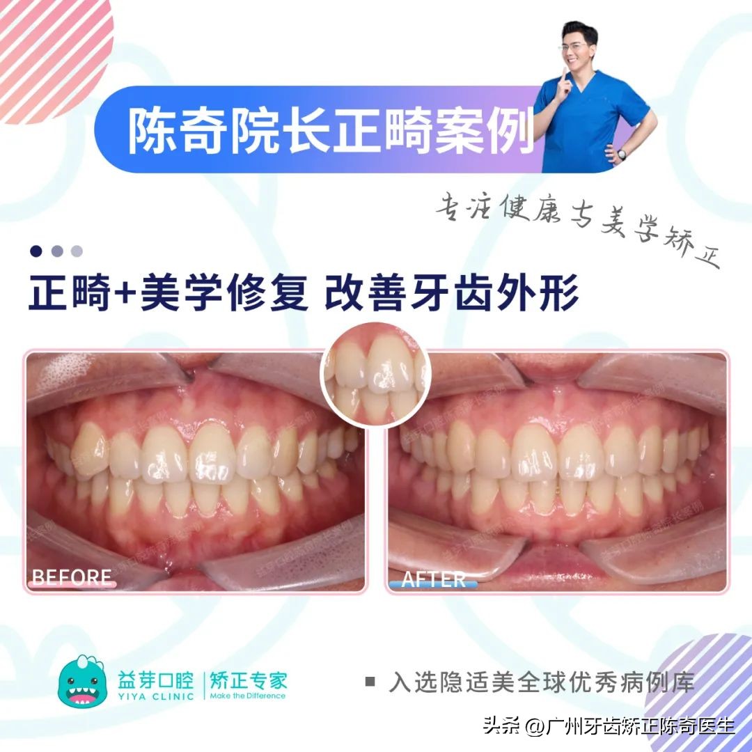 正畸治疗的基本矫治方法,正畸修复联合案例