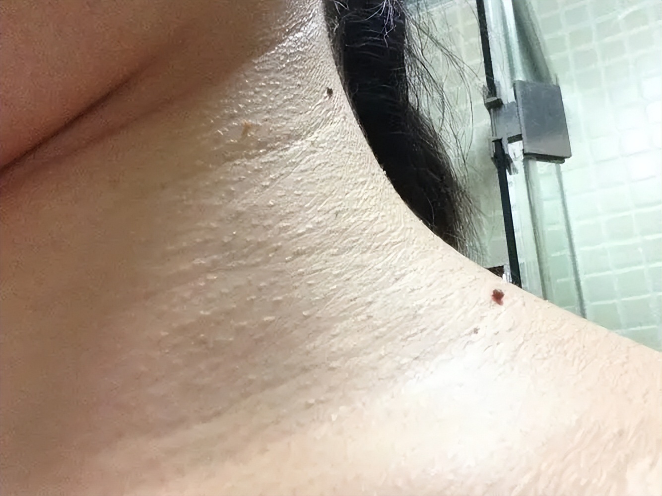 脖子和腋下总长“小肉粒”？可以用手揪吗？医生：与7种疾病有关