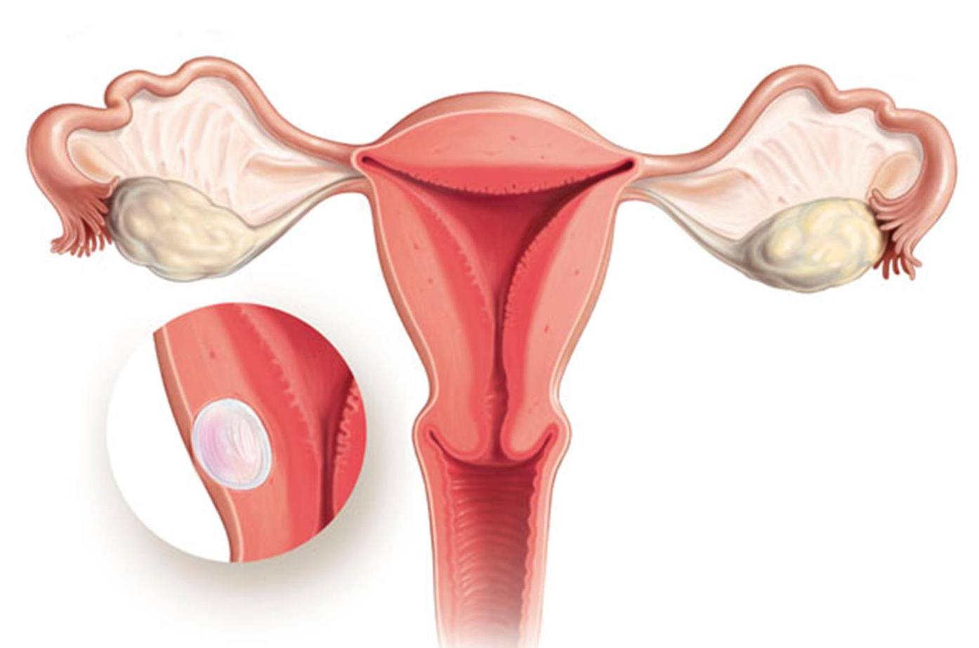 26岁子宫肌瘤8cm最好的手术方法,子宫肌瘤小需要手术吗