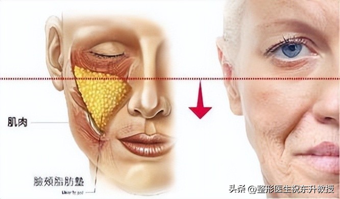 拉皮改善法令纹手术的危害有哪些,脸部法令纹做手术怎么去除