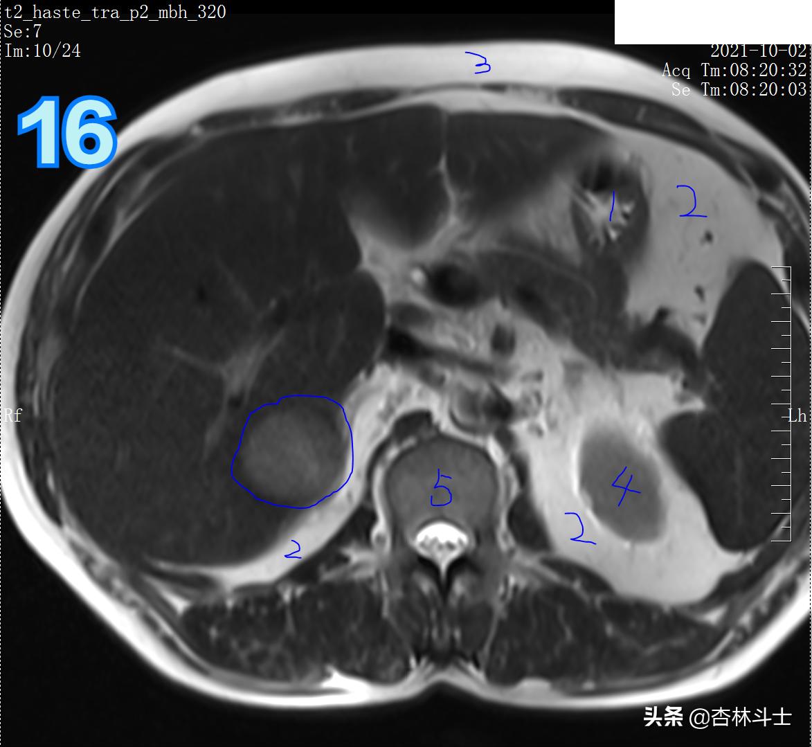 肝癌8公分肿瘤能活多久,肝癌细胞最大长多大