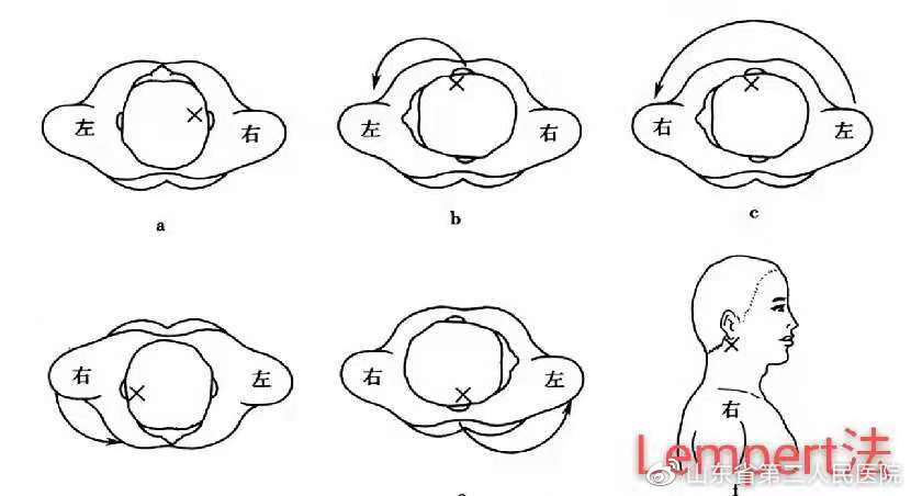耳朵里的小石头,耳朵里像是有一个小石头