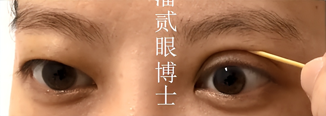 凸眼球显得眼睛大,凸眼眼窝凹陷