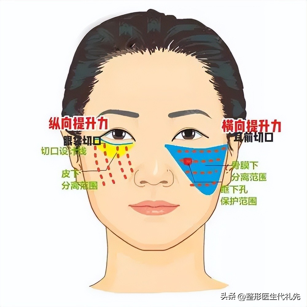 去眼袋外切是什么样的,做外切眼袋会改变眼睛的形状吗
