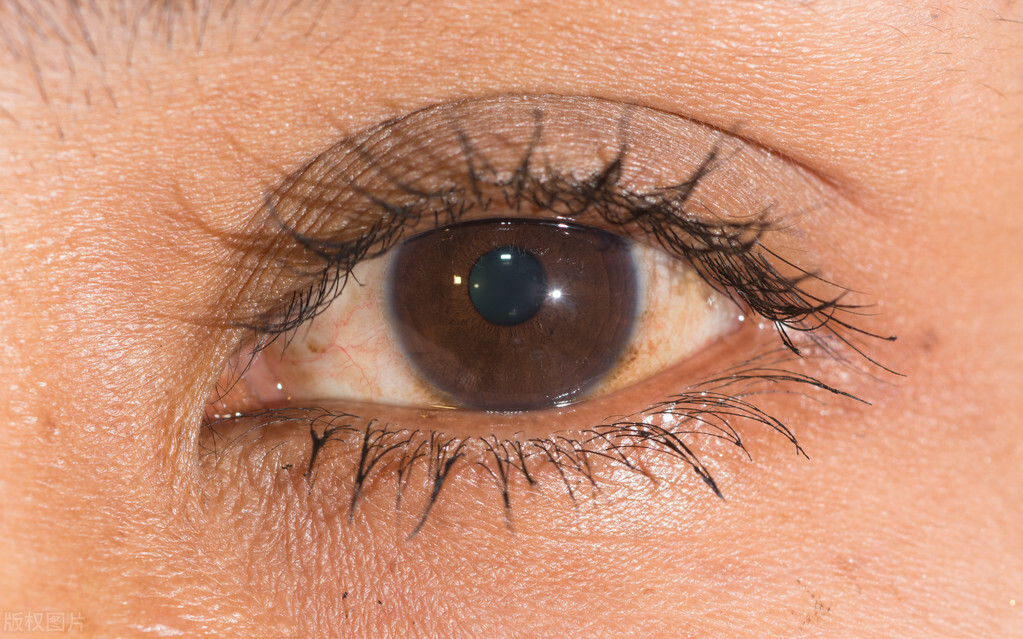 老年斑怎么去掉有什么办法,年轻人怎样预防以后老了有老年斑