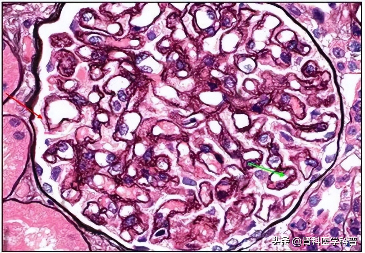 利妥昔单抗能治疗膜性肾病？