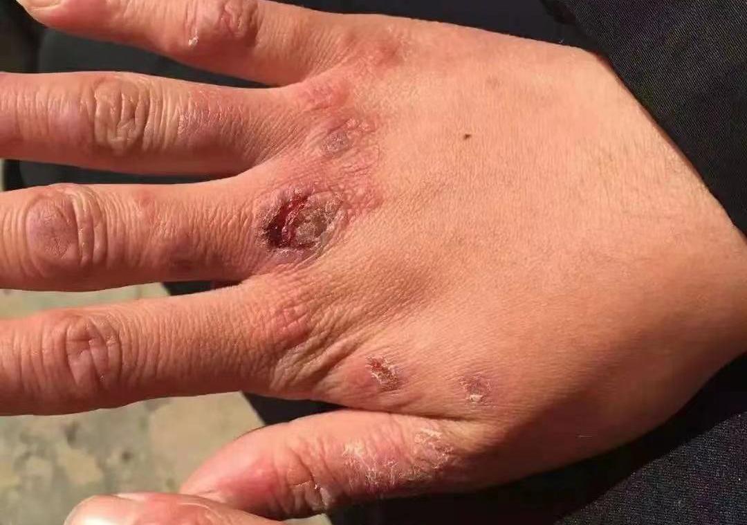 冻疮高发季怎么处理,冬季皮肤长冻疮怎么办