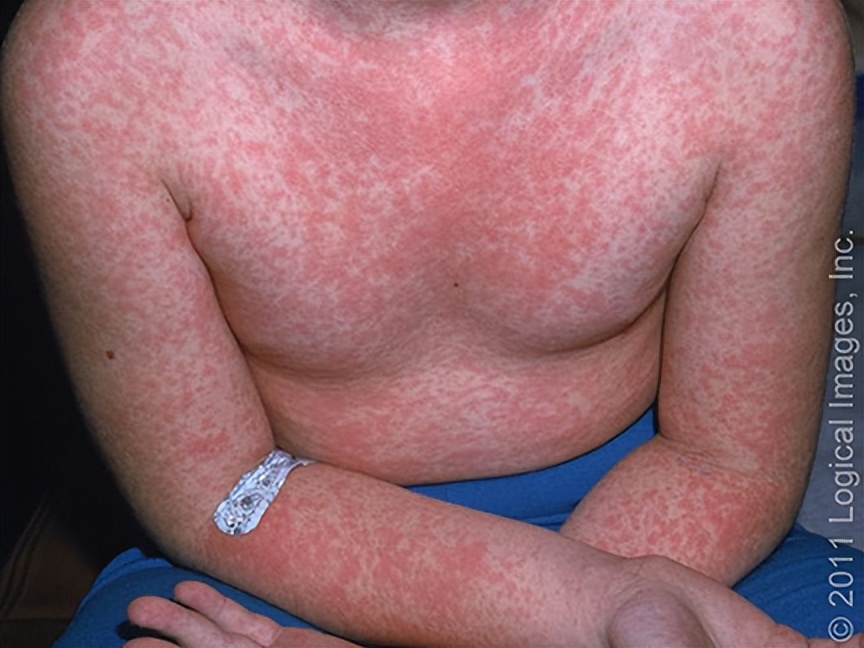 药物反应引起皮肤瘙痒,吃药后皮肤出现药疹