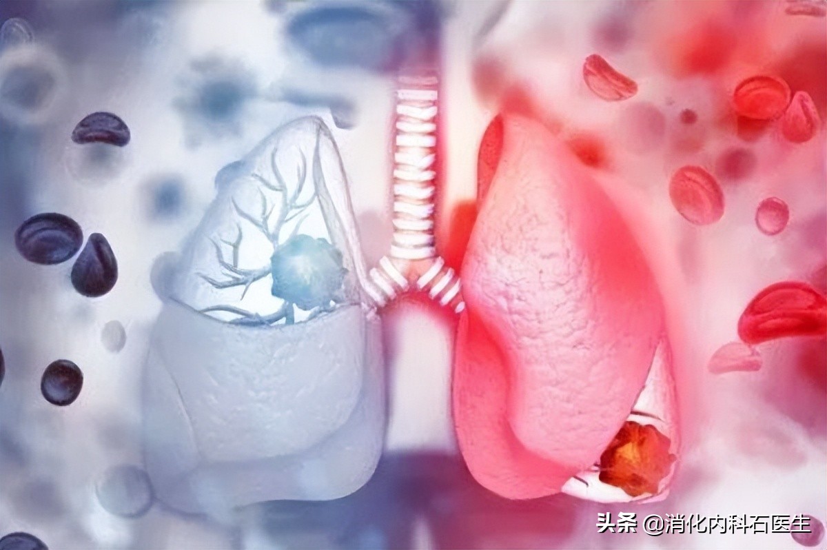 咳血误诊肺癌,男子肺癌被误诊为肺结核
