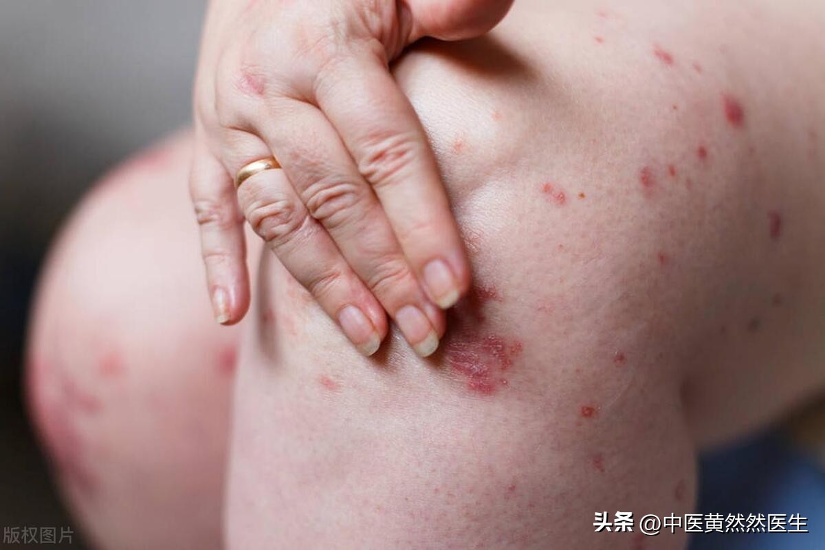 补气血祛湿气经方,湿在脾上吃什么中成药