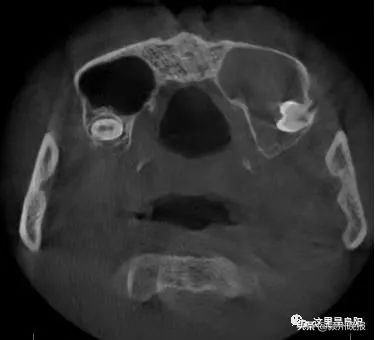 一小伙鼻窦里面长了颗牙,极其罕见男子鼻子里竟长了颗牙