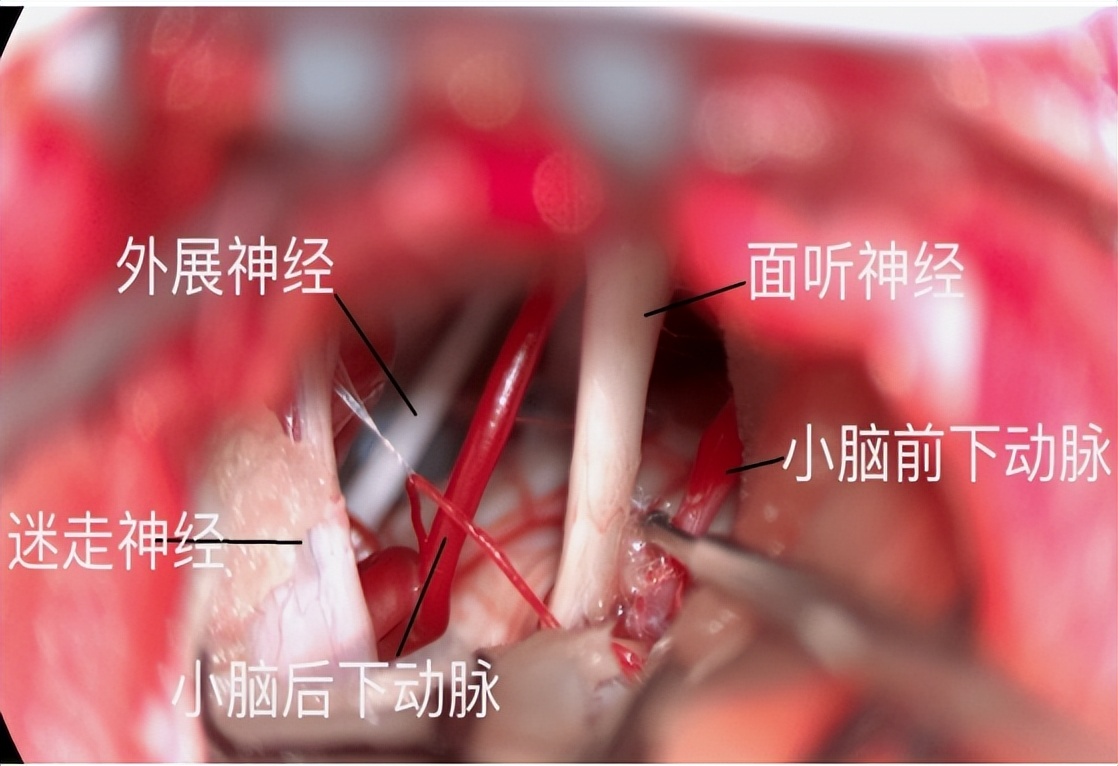 面肌痉挛会不从眼皮开始发病吗,什么是面肌痉挛该如何治疗