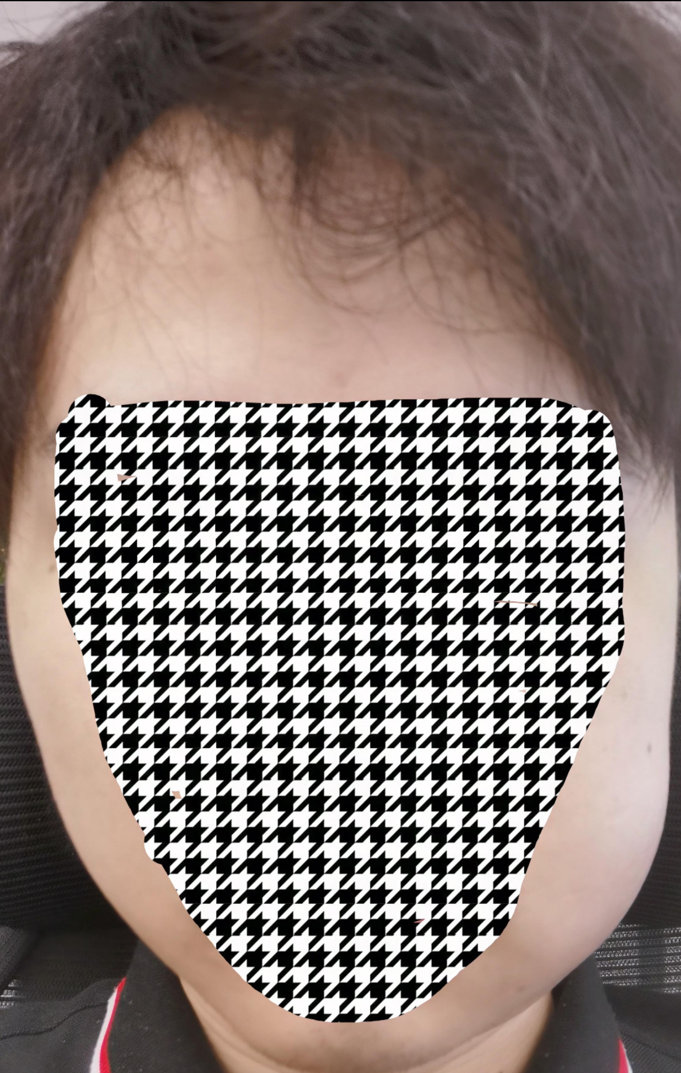 左下智齿拔除视频怎么正确拔除,复杂智齿拔除操作详细流程