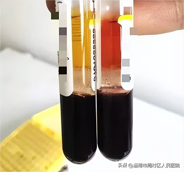 血液标本溶血对检测的影响,血液标本出现溶血是什么意思