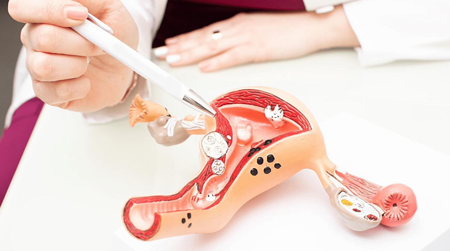 7cm巧囊不用做手术！一剂中医古方补肾祛瘀，消散囊肿有良效