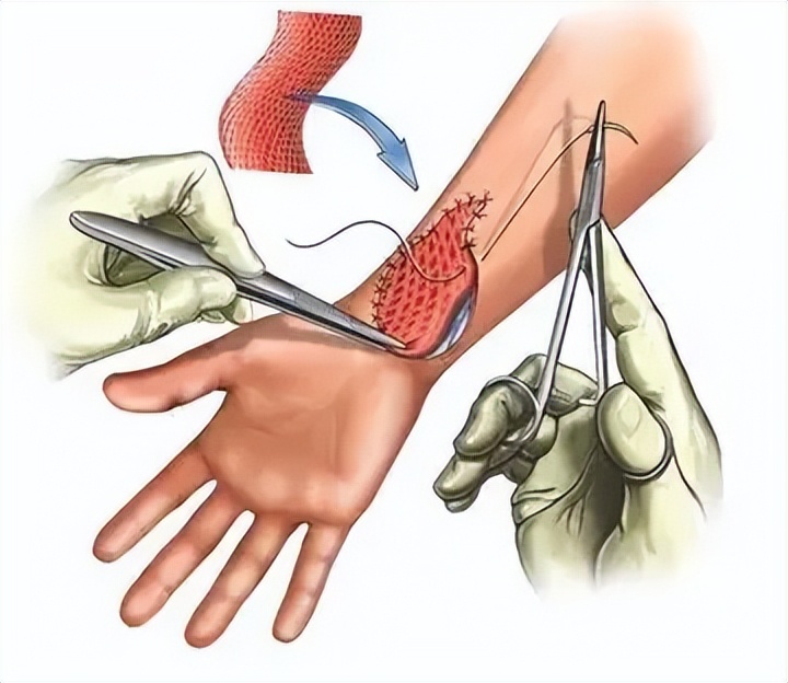 20多岁包皮一定要割吗,40岁了包皮还有必要割吗