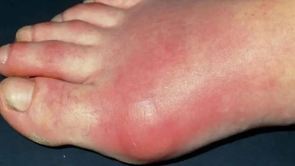 常吃花生能治便秘吗,经常吃生花生米可以治便秘吗