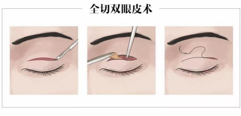 高考完想整容,高考结束去做双眼皮好吗