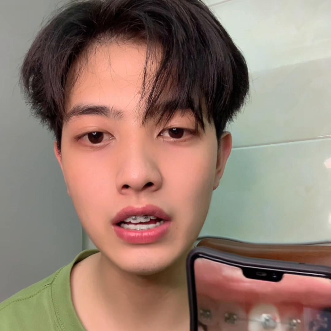 牙套怎么固定在牙上的,牙套矫正过程