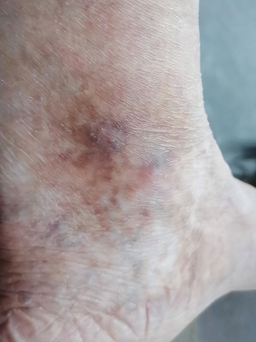 花都中医院病例,花都有多少病例