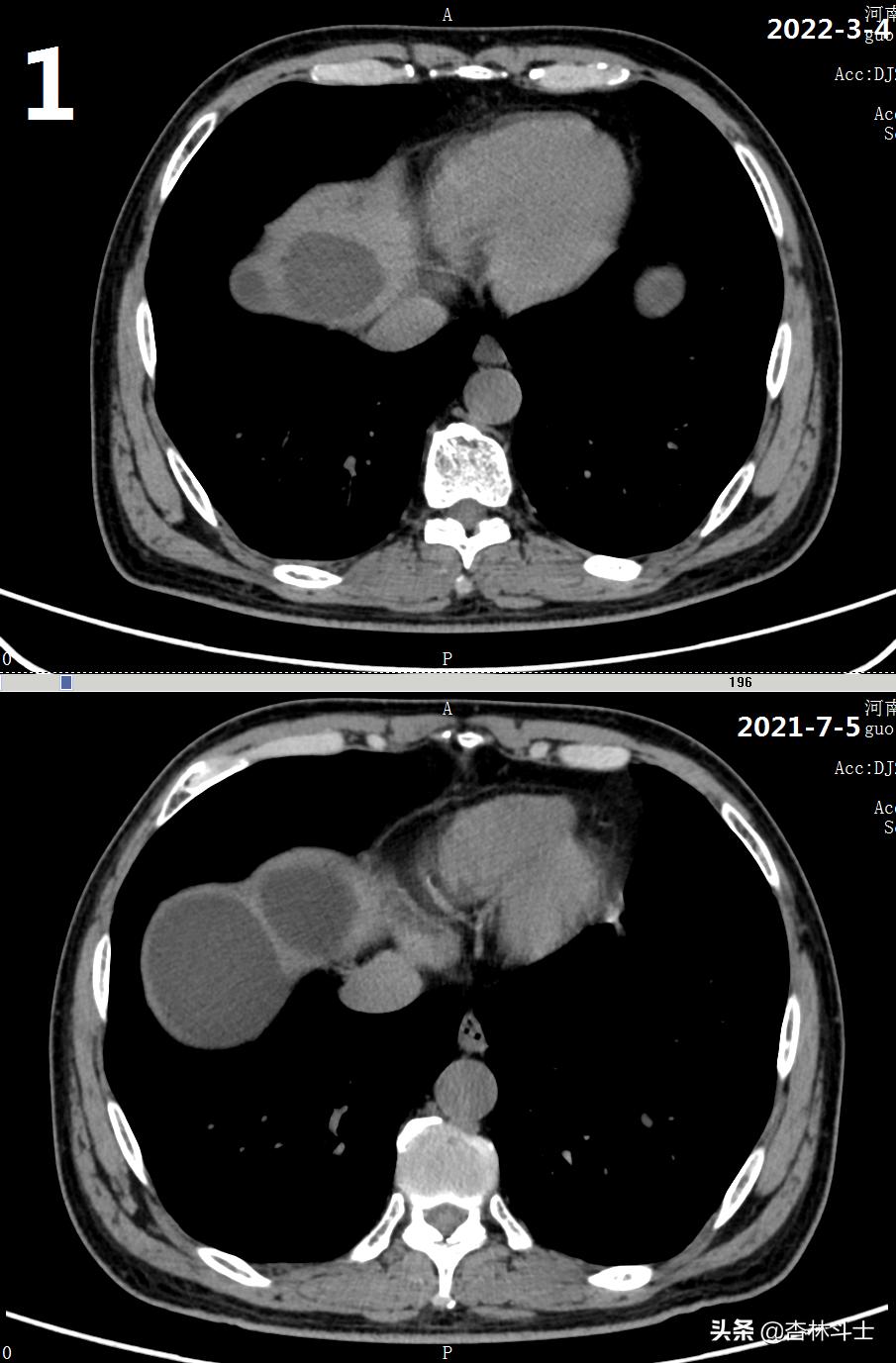 64岁银行职员患肝囊肿,CT引导下细针穿刺抽吸酒精硬化解决大问题