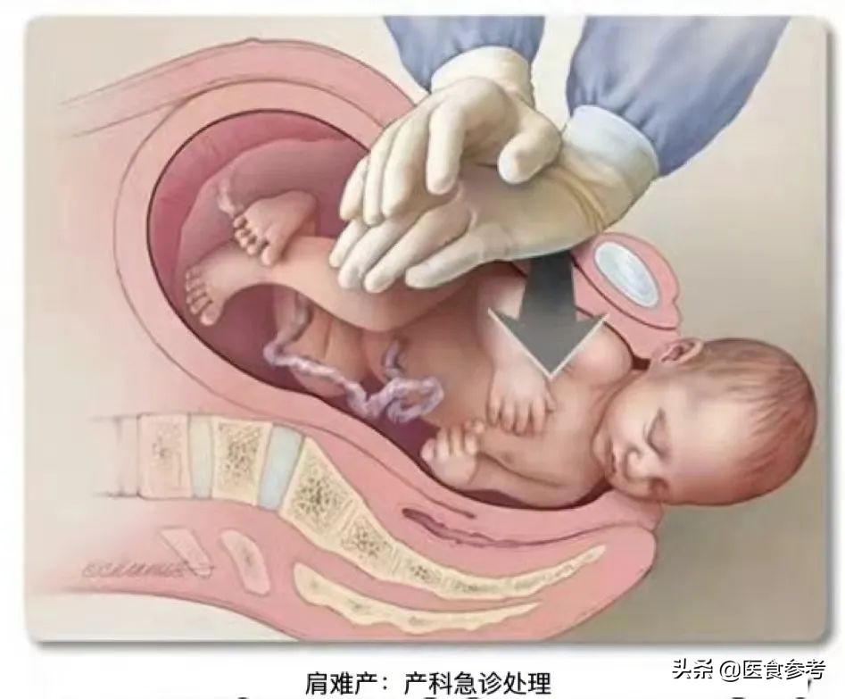 新生儿孩子臂丛神经被拔断,新生儿臂丛神经被拉断还能接上吗