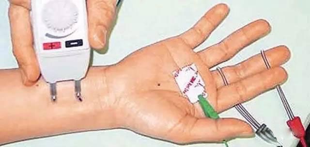 鼠标手腕管综合征挂什么科,白领鼠标手腕管综合征