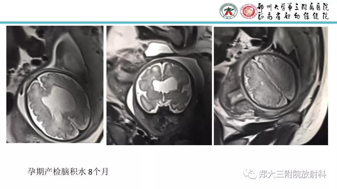 透明隔腔主要是判断什么,透明隔腔宽约10mm什么意思