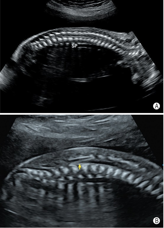 2022年产前超声筛查指南,胎儿超声异常的产前诊断