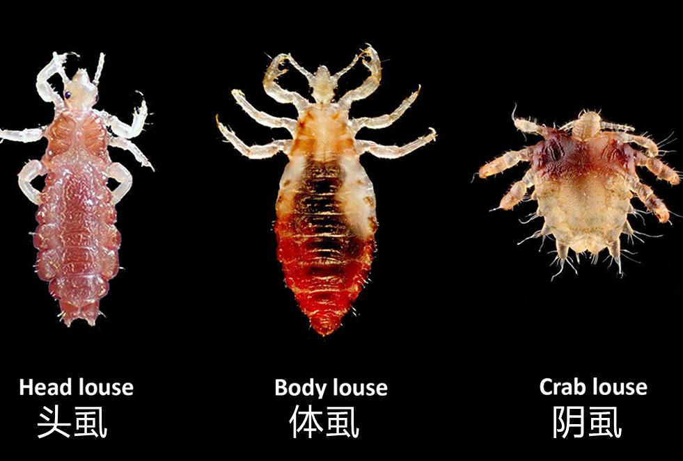 医生检查阴虱的镊子和刀片,男子发现阴虱