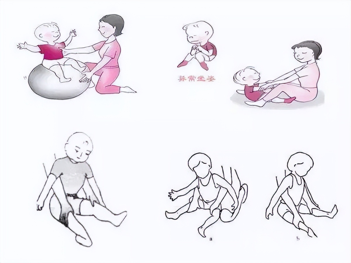 治疗脑瘫第一人,痉挛型脑瘫最新治疗方法