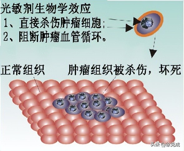 徐克成大讲堂,徐克成谈癌症克星