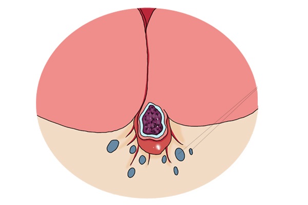 外阴假性尖锐湿疣痒,外阴尖锐湿疹是什么原因引发的