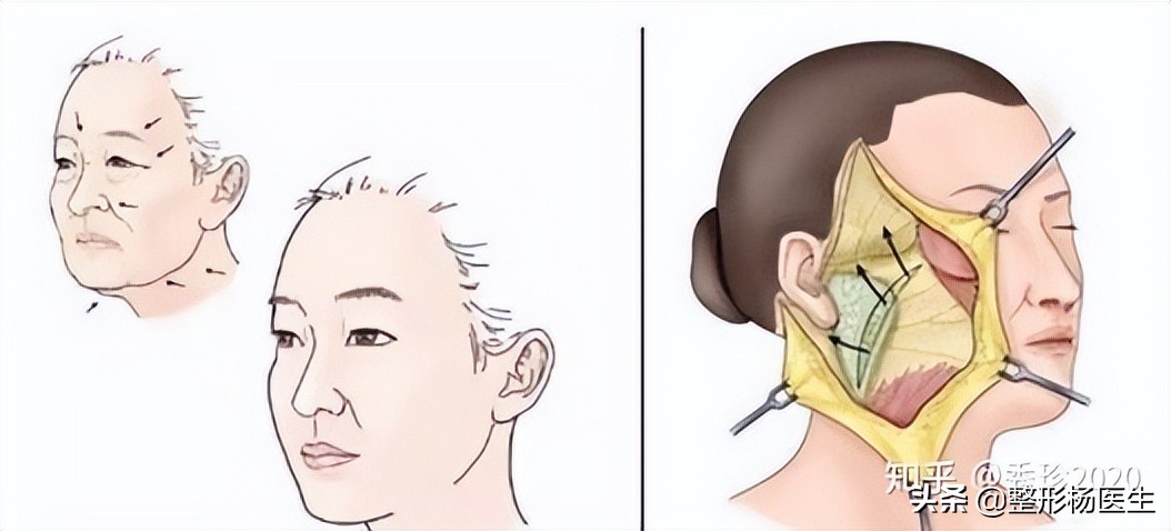 拉皮手术危险有真相,做拉皮手术后遗症