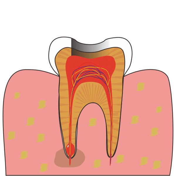 没蛀的牙齿痛需要做根管治疗吗,牙髓摘除是不是就是根管治疗