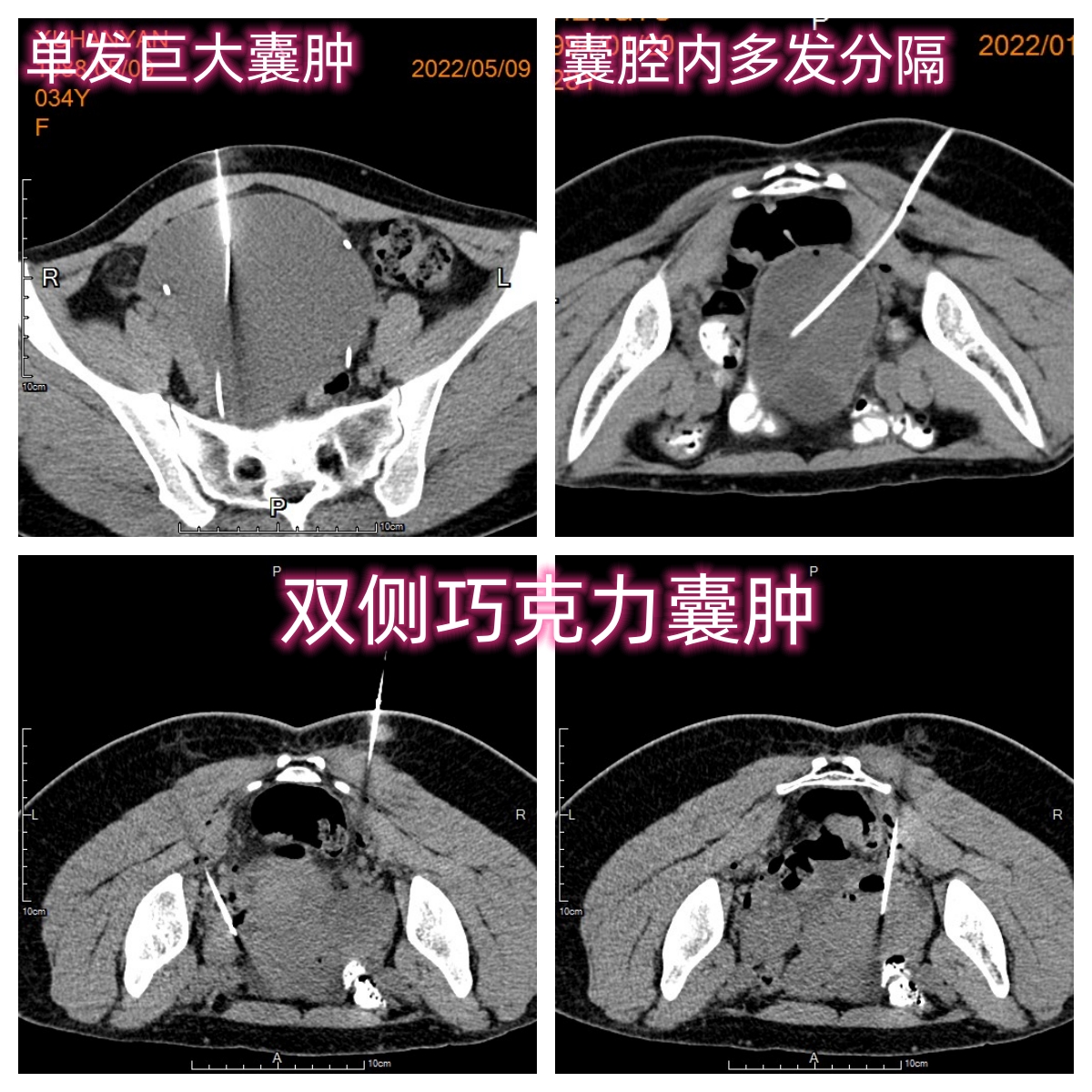 巧克力囊肿穿刺好还是腹腔镜好,卵巢巧克力囊肿做腹腔镜还是穿刺