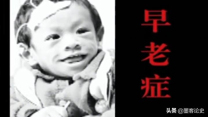 故事:河南1岁女婴患早老症,一夜变成80岁老人,母亲含泪千里求医