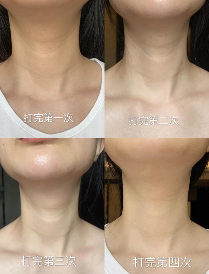 1条颈纹=显老10岁，可怕的颈纹还有救吗？