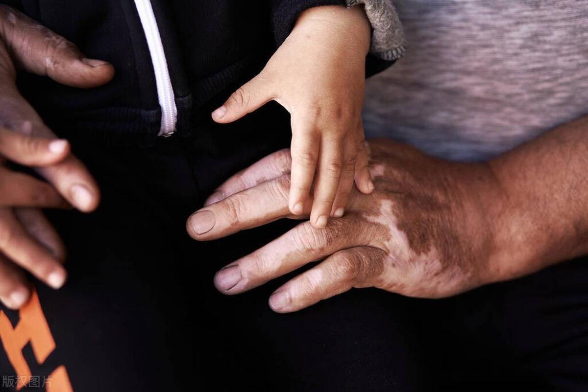 嘴唇皮肤发白是白癜风吗,皮肤褪色怎么回事