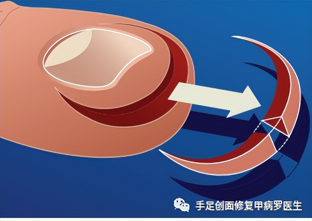 宝宝脚趾甲有脓了怎么处理,给宝宝剪指甲流脓怎么办