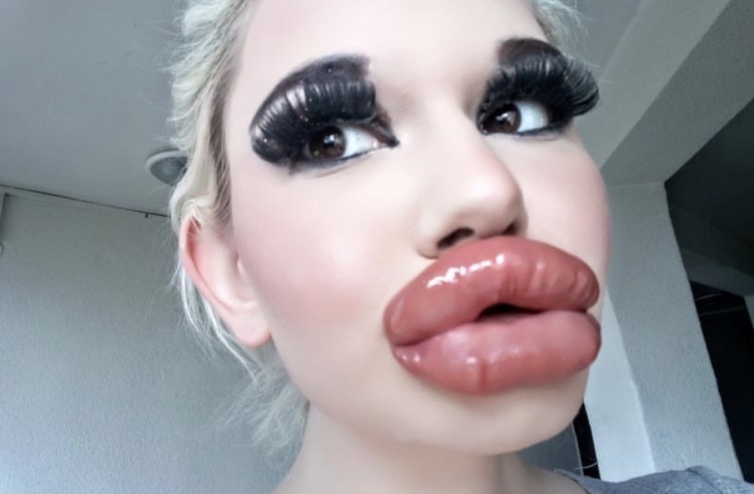 女子狂打30支玻尿酸,丰唇针建议打吗