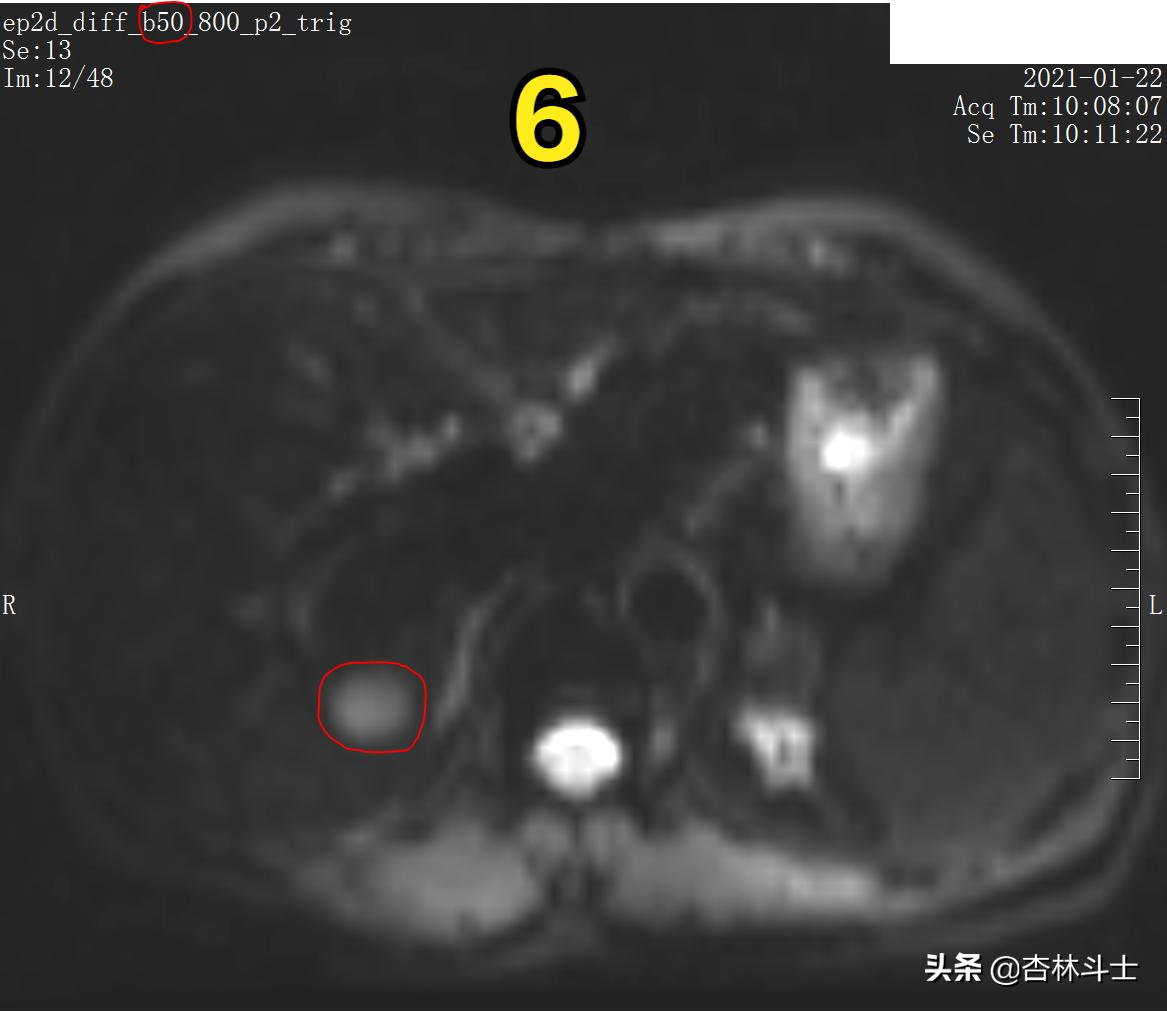 肝癌8公分肿瘤能活多久,肝癌细胞最大长多大