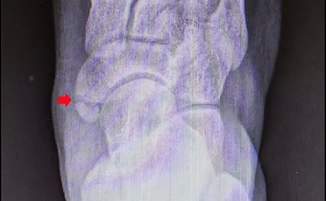 小孩运动后脚疼怎么办,孩子运动后足内侧疼痛