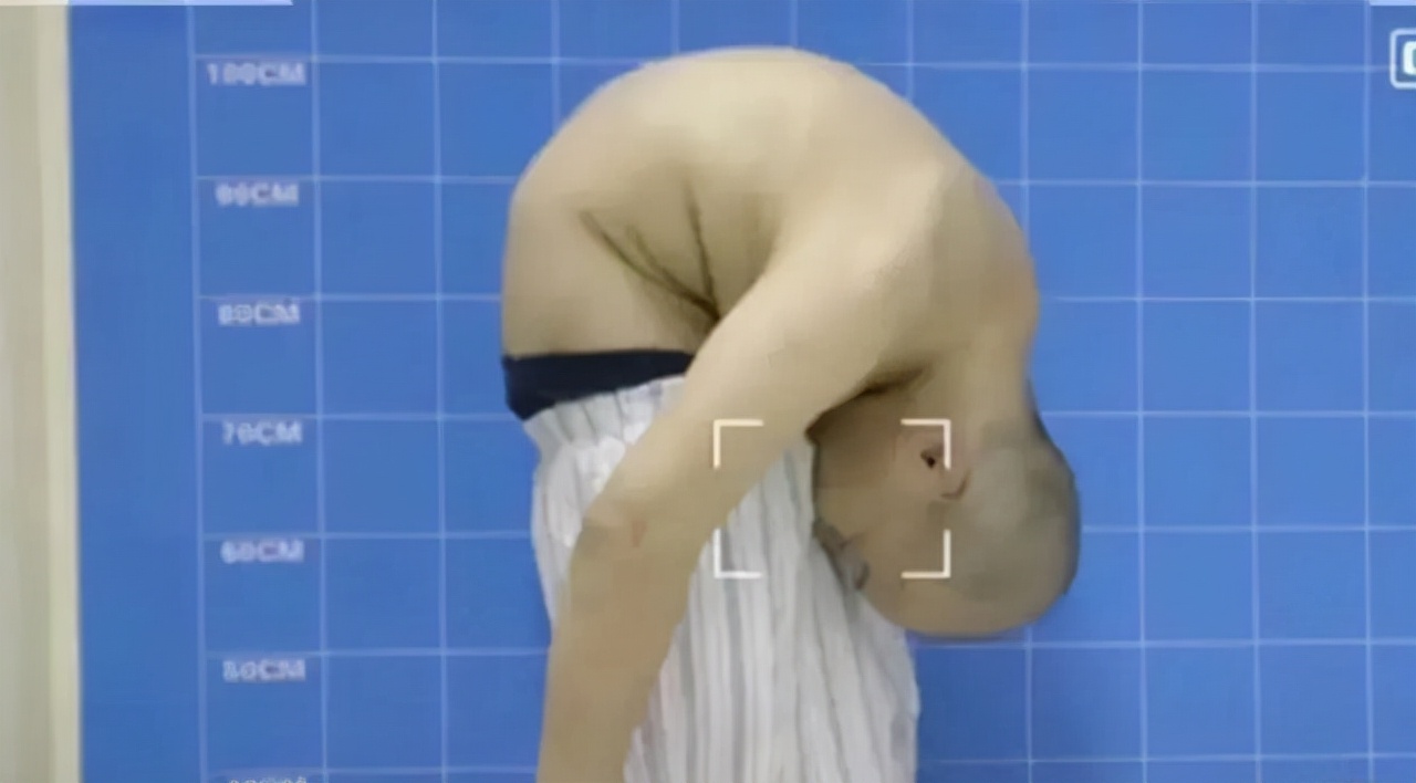 折叠人李华后续,折叠人李华四次手术完整版