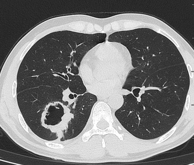 肺脓肿导管引流,肺脓肿的引流管脱落怎么办