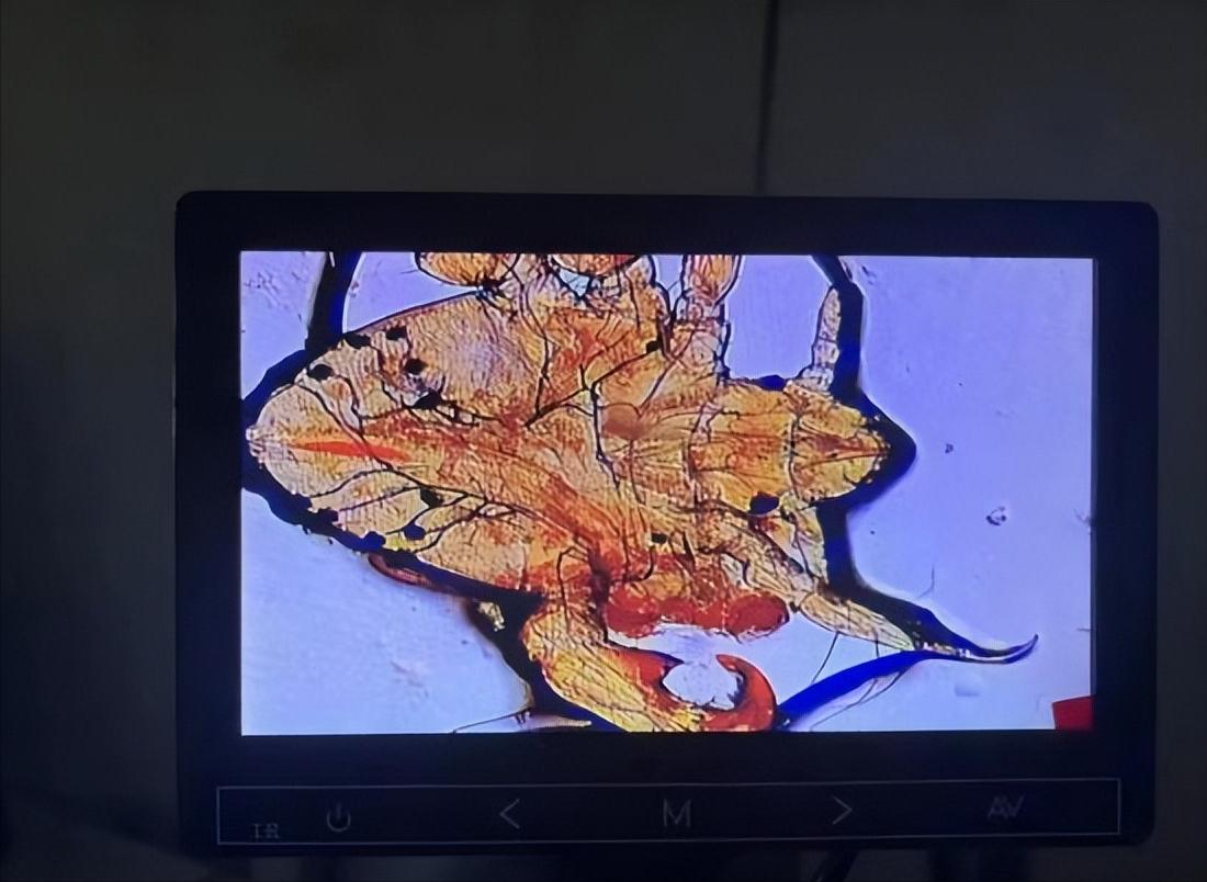 孩子眼睛长阴虱怎么处理,阴虱长在小孩眼睫毛上