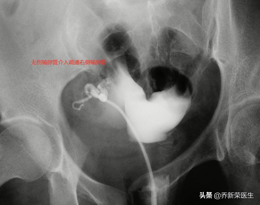 32岁双侧输卵管堵塞,42岁输卵管堵塞严重腹腔镜疏通