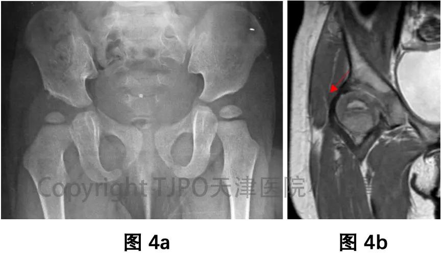 髋关节发育不良做完截骨术,髋关节发育不良截骨矫正能撑多久